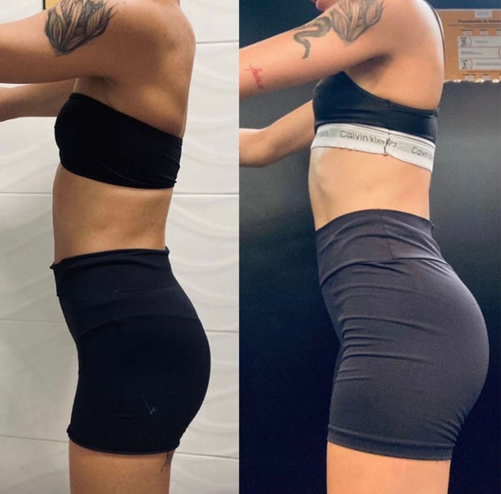 Personal Especialista em Aumento de bumbum